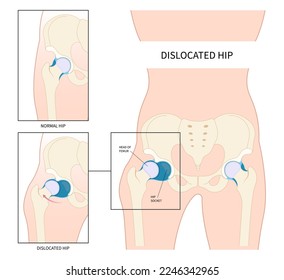 Sciatic nerve compression in prosthesis pelvis thighbone joint dislocated broken pain of leg bone treat unstable femur neck chronic damage sport labral tear child hurt thigh closed loose baby birth