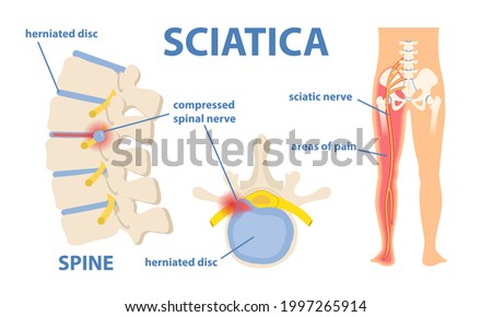 Sciatic nerve pain in the lower back through hip, thigh, knee to leg. Educational or informational poster. Flat vector medical illustration isolated on white background Stock photo © 