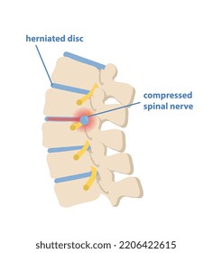 Sciatic nerve pinching concept. Pain in lumbar spine between vertebrae. Hernia of spinal cord. Design element for anatomy or education books. Cartoon flat vector illustration on white background