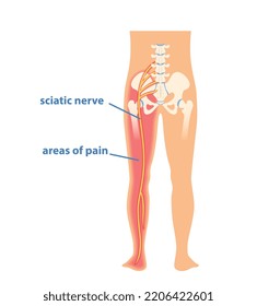 Pinchamiento del nervio ciático. Silueta corporal humana con síndrome de piriformis. Área de dolor de hernia. Dolor de garganta. Medicina y tratamiento de enfermedades. Dibujo vectorial plano de dibujos animados sobre fondo blanco