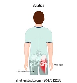 Sciatica. Áreas de dolor. Nervio ciático desde la parte inferior de la espalda y la cadera a través de las caderas hasta la pierna. 