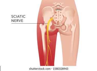 Sciatica - close-up of sciatic nerve and radiant pain pathway