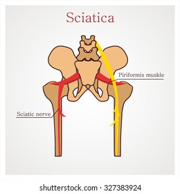 Sciatica. The main causes of sciatica.
