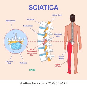 Sciatica medical diagram. Anatomical scheme with human spine, nerves and intervertebral disc. Infographic with sciatic nerve compression and leg pain. Hernia in lumbar spine. Flat vector illustration