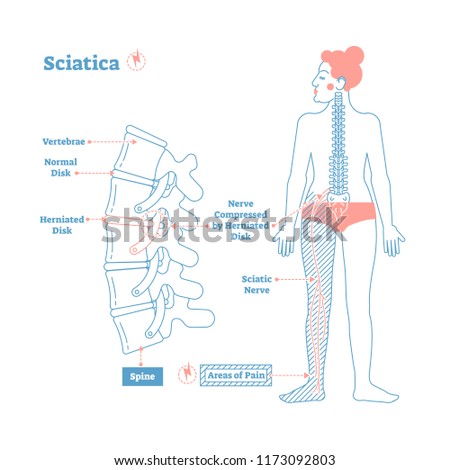 Sciatica medical health care vector illustration scheme with lower spine and sciatic nerve pain in leg. Backbone diagram with vertebrae, disks and nerves. Full woman patient body from back.