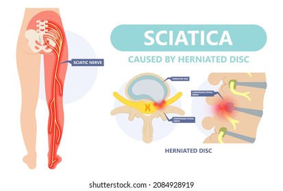 Sciatica nerve pain lower back through hips to leg