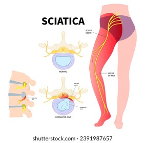 The Sciatica nerve pain of lower back through hips to leg and degenerative disc disease