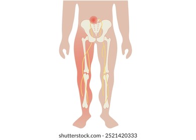 Dolor del nervio ciático que irradia desde la parte inferior de la espalda hacia abajo de la pierna, causado por la compresión del nervio ciático. Las afecciones relacionadas incluyen hernia discal, estenosis espinal, síndrome piriforme, dolor en la pierna