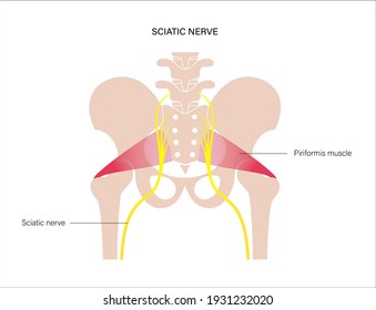 sciatica pain and inflammation in pelvis, leg and hip. Piriformis muscle syndrome concept. Human nervous system and skeleton anatomical poster. Medical flat vector illustration for clinic. X ray image