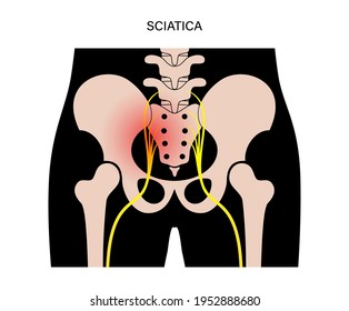 sciatica pain and inflammation in pelvis, leg and hip. Piriformis muscle syndrome concept. Human nervous system and skeleton anatomical poster. Medical flat vector illustration for clinic. X ray image