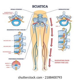 Sciatica pain or nerve weakness as leg lumbar radiculopathy outline diagram. Labeled educational back inflammation, piriformis syndrome and degenerative spinal disc problem vector illustration.