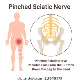 Sciatica. Pinched sciatic nerve causing pain and inflammation in pelvis, leg and hip. Human nervous system and skeleton anatomical poster. Flat vector illustration