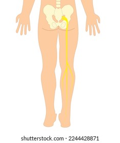 Sciatica - sciatic nerve Pain illustration in the right leg 