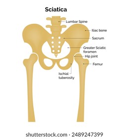 Sciatica Science Design Vector Illustration Diagram