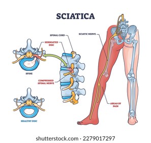 Sciatica as symptom from herniated disc and spinal nerve outline diagram. Labeled educational scheme with medical condition from compressed nerves and compared with healthy disc vector illustration.