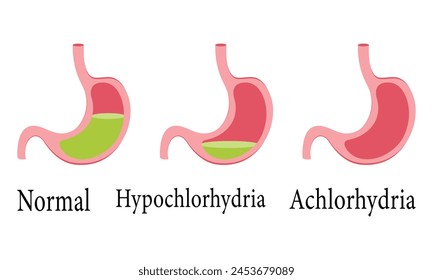 Scientific Designing of Normal Cell Hypochlorhydria and Achlorhydria Vector Illustration.