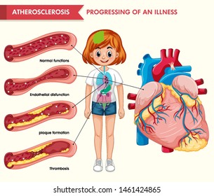 Scientific medical illustration of atherosclerosis illustration