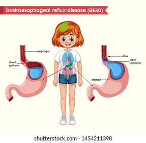 Scientific medical illustration of GERD illustration