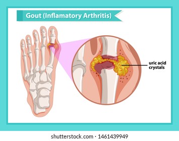 Scientific medical illustration of gout arthritis illustration