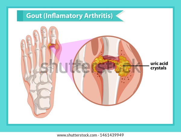 Wissenschaftliche Medizinische Illustration Von Gicht Arthritis Stock Vektorgrafik Lizenzfrei