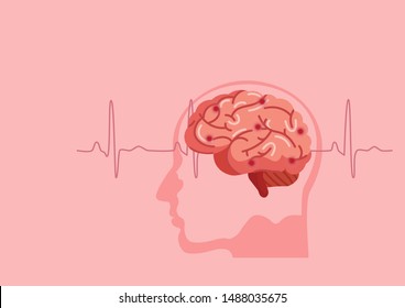 Scientific Medical Illustration Of Human Brain Stroke Illustration. Types Of Human Brain Stroke Illustration. Vector, Esp