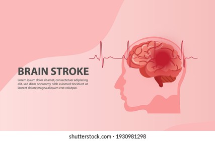 Scientific Medical Illustration Of Human Brain Stroke Illustration. Types Of Human Brain Stroke Illustration. Vector, Esp