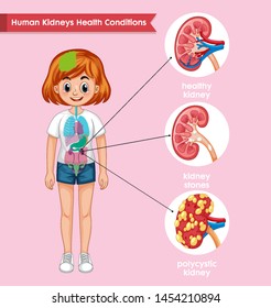 Scientific Medical Illustration Of Kidney Disease Illustration