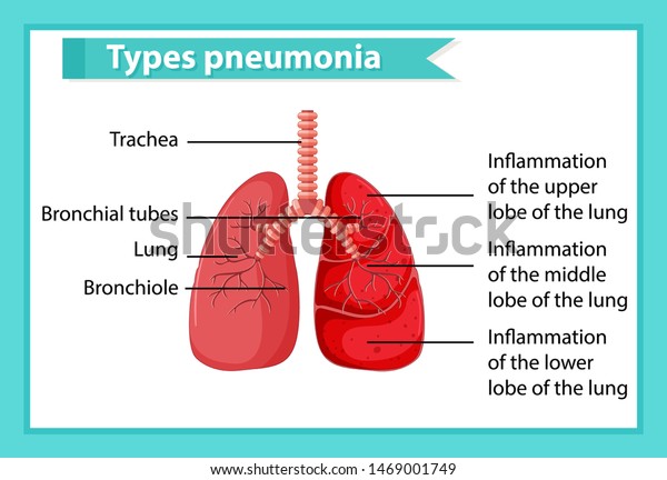 Scientific Medical Illustration Pneumonia Illustration Stock Vector ...