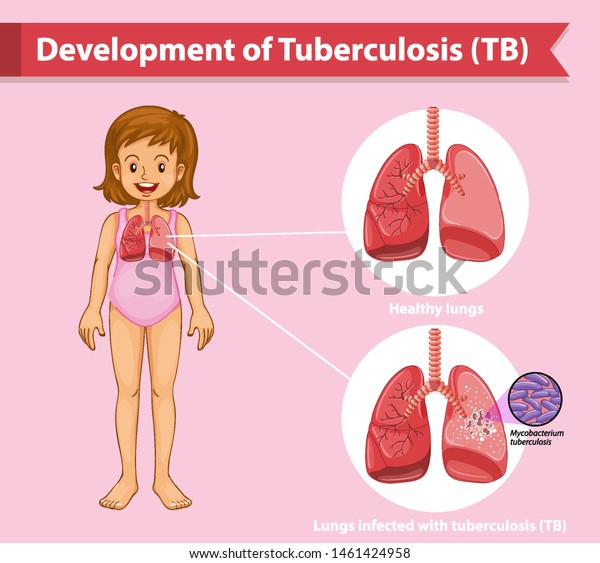 Scientific Medical Illustration Tuberculosis Tb Illustration Stock