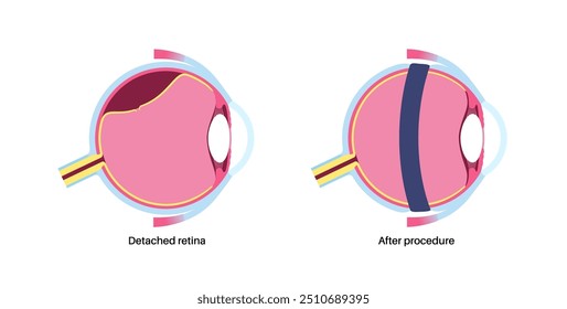 Cirurgia da fivela escleral. Procedimento usado para reparar o descolamento da retina colocando uma faixa de silicone ao redor do olho para aliviar a tração da retina. Restaurar a visão e prevenir a ilustração do vetor de cegueira