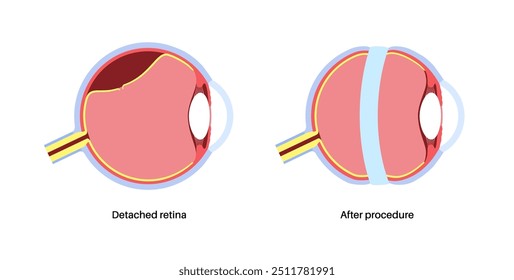 Cirurgia da fivela escleral. Procedimento usado para reparar o descolamento da retina colocando uma faixa de silicone ao redor do olho para aliviar a tração da retina. Restaurar a visão e prevenir a ilustração do vetor de cegueira