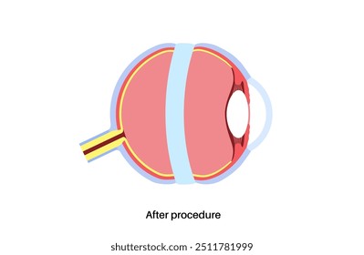 Cirurgia da fivela escleral. Procedimento usado para reparar o descolamento da retina colocando uma faixa de silicone ao redor do olho para aliviar a tração da retina. Restaurar a visão e prevenir a ilustração do vetor de cegueira