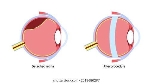 Cirurgia da fivela escleral. Procedimento usado para reparar o descolamento da retina colocando uma faixa de silicone ao redor do olho para aliviar a tração da retina. Restaurar a visão e prevenir a ilustração do vetor de cegueira