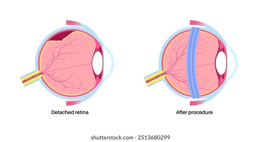 Scleral buckle surgery. Procedure used to repair retinal detachment by placing a silicone band around the eye to relieve retinal traction. Restoring vision and preventing blindness vector illustration