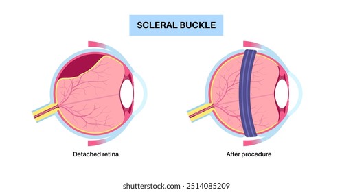 Sklerale Schnallen-Operation. Verfahren zur Reparatur der Netzhautablösung, indem ein Silikonband um das Auge gelegt wird, um die Netzhauttraktion zu lindern. Wiederherstellung des Sehvermögens und Verhinderung von Blindheit, Vektorgrafik