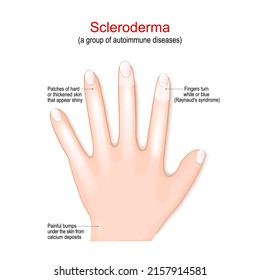 Scleroderma is a group of autoimmune diseases. Signs and symptoms. close-up of a Human's hand with white Fingers. Raynaud's syndrome. Patches of hard or thickened skin that appear shiny. Vector