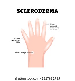 Scleroderma Hand Disease Symptoms Medical Illustration. Showing thickened skin and tightened fingers. Fingers turn white. Painful bumps, Dermatology. Autoimmune disease. Flat vector illustration.