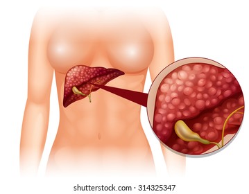 Sclerosis cancer in human body illustration