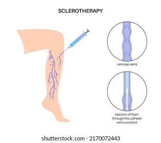 Sclerotherapy surgery, varicose and spider veins treatment medical procedure. Injecting a solution or foam directly into the vein through the catheter. Leg disease medical flat vector illustration.