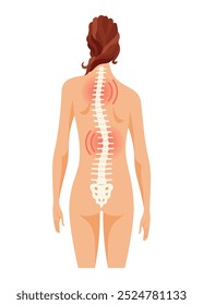 Scoliosis affecting individuals of all ages. Schematic poster of a woman with scoliosis