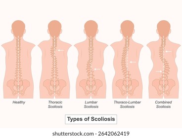 Scoliosis is a condition where the spine curves abnormally to the side,often resembling a "C" or "S" shape when viewed from behind.Medical health care, Vector illustration.
