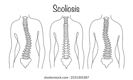 Escoliose. Curvatura da coluna vertebral em relação ao seu eixo. Um homem com as costas saudáveis e um homem com escoliose. Linha desenhada ilustração sobre um tema médico. Vetor.