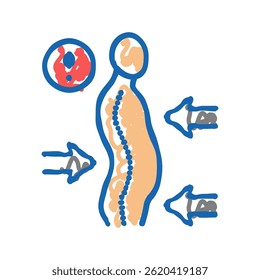 scoliosis disease doodle icon sketch vector. scoliosis disease sign. isolated symbol illustration