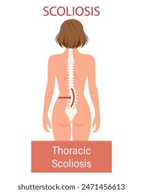 Escoliosis, una enfermedad de la columna. Anuncio infográfico con escoliosis de la columna humana. Salud y medicina. Ilustración