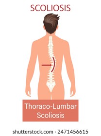 Scoliosis, a disease of the spine. Infographic banner with scoliosis of the human spine. Healthcare and medicine. Illustration