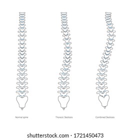Scoliosis Flat Vector Illustration. Types Of Scoliosis Of Spine Infographics. Diagram With Spine Curvatures And Healthy Backbone. Body Posture Defect. Medical, Educational And Science Banner