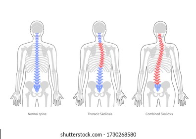 Scoliosis flat vector illustration. Types of scoliosis of spine infographics. Diagram with spine curvatures and healthy backbone. Body posture defect. Medical, educational and science banner