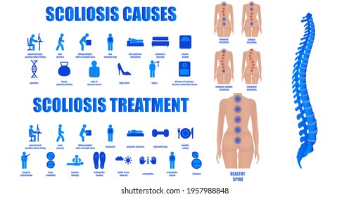 Scoliosis infographics. A set of icons on the topic of the causes and treatment of scoliosis. Curvature of the spine. Image of a healthy and uneven back of a girl. Medical educational poster.