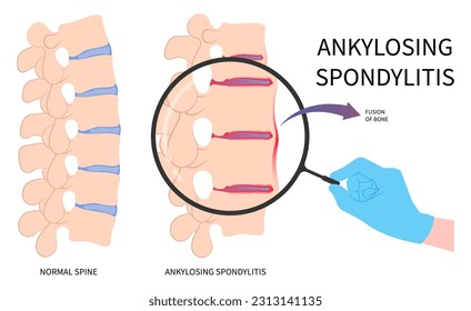 scoliosis kyphoscoliosis disease in axial ankylosing spondylitis osteoporosis and fused spine disk of kyphosis lordosis the skeletal pelvis stiffness with chronic knee ankle spondylolysis