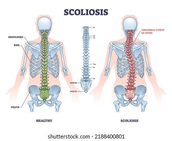 Scoliosis As Medical Sideways Curvature Illness Of Spine Outline Diagram. Labeled Educational Scheme With Healthy And Abdominal Backbone Skeleton Comparison Vector Illustration. Deformity Posture.